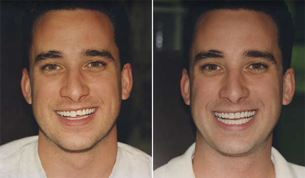 Pictures Of Before And After Veneers. Notice how dental veneers can
