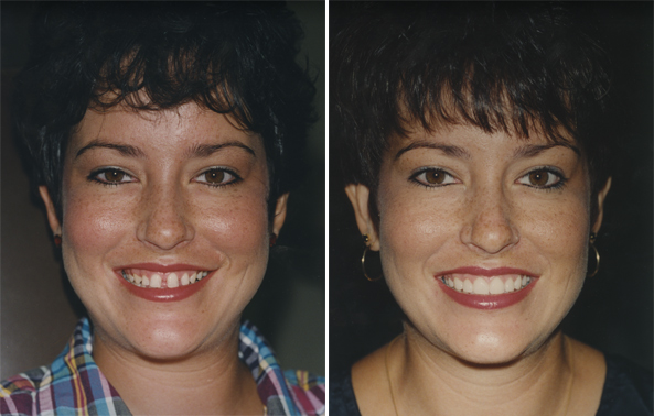 Before And After Pics Of Braces. Before and After Invisible